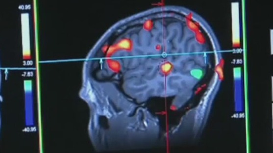 Viagra may be able to reduce risk of Alzheimer's disease