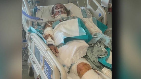 Woman in serious condition after she was attacked by 3 pitbulls