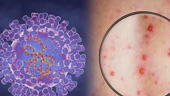 Health officials warn Monkeypox spread as children prepare to go back to school