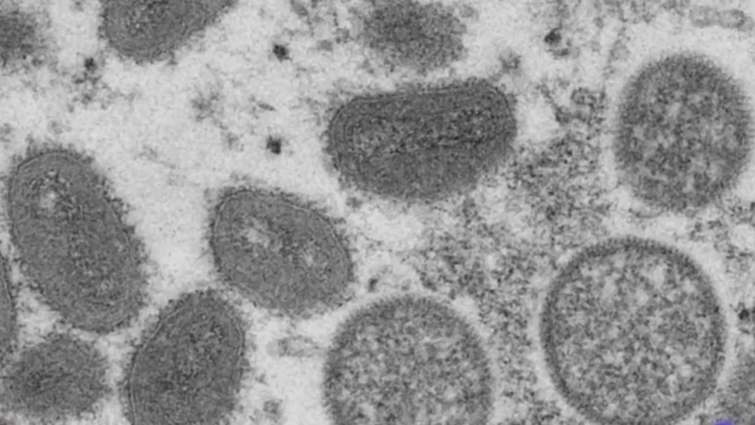 Monkeypox update: Doctor explains how infections are transmitted, status of vaccine availability
