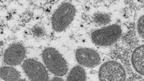 Houston?s Chief Medical Officer discusses concerns parents have about Monkeypox