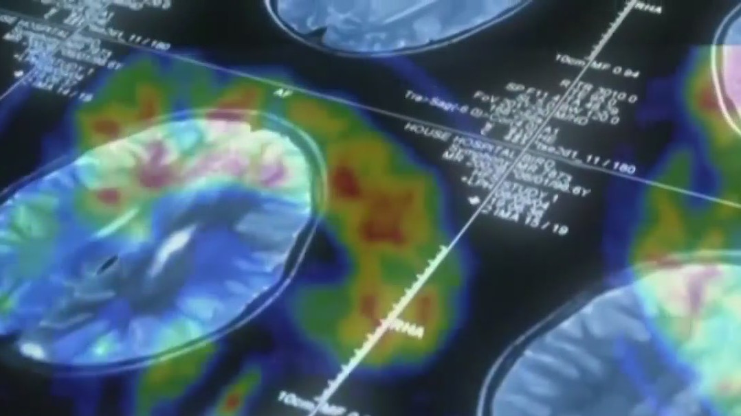 New data shows Alzheimer's drug can slow cognitive decline