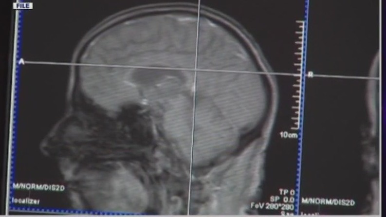 Study: Social media can impact brain development in young people