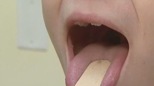 Invasive strep throat rising in the U.S., Texas