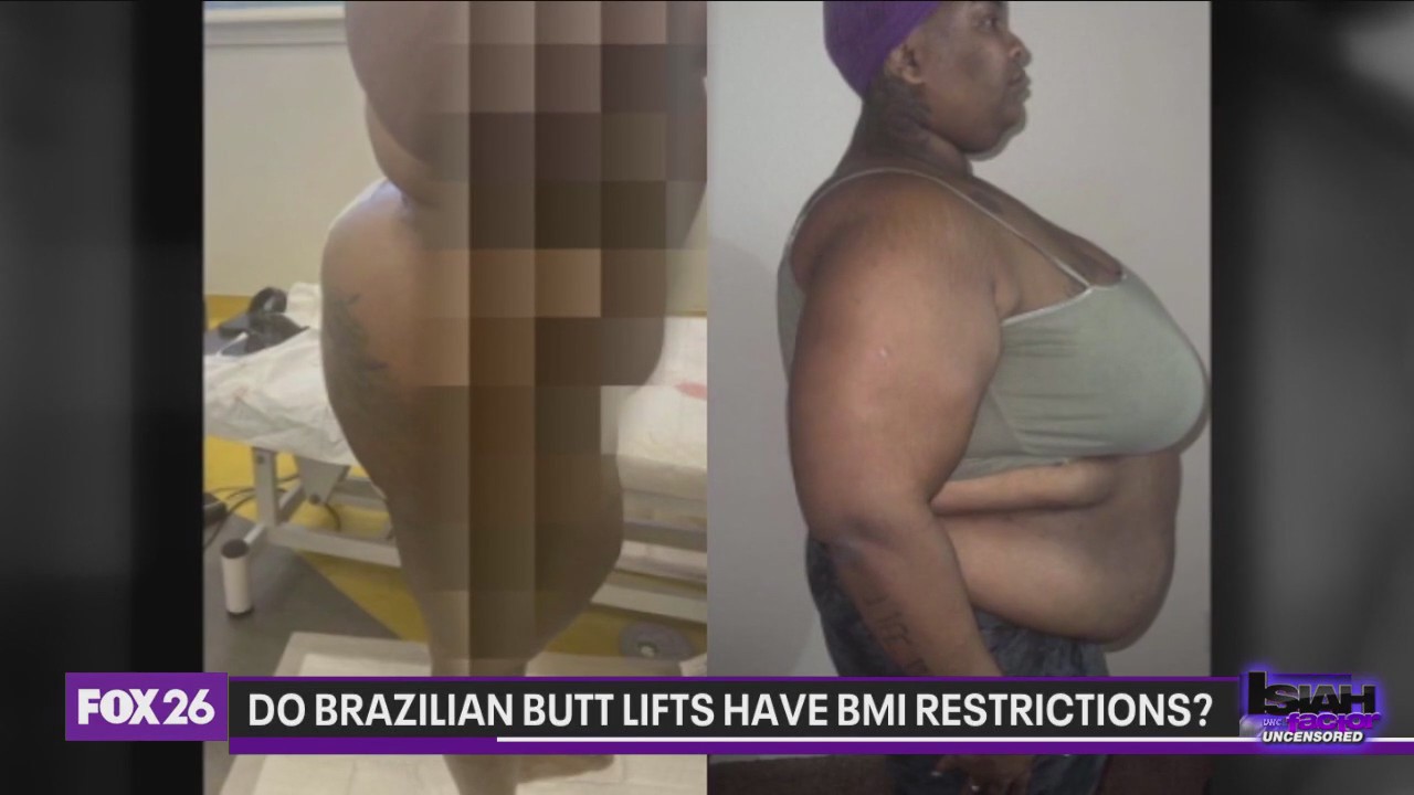 Do Brazilian Butt Lifts have BMI restrictions?