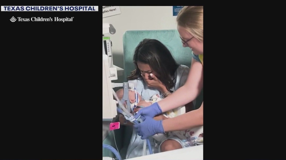 Texas conjoined twins separated after surgery