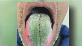 Man's tongue green after years of smoking