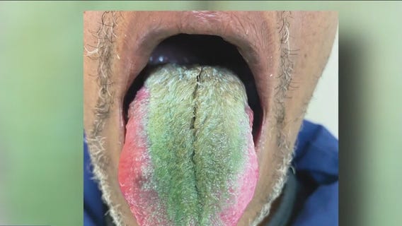 Man's tongue green after years of smoking