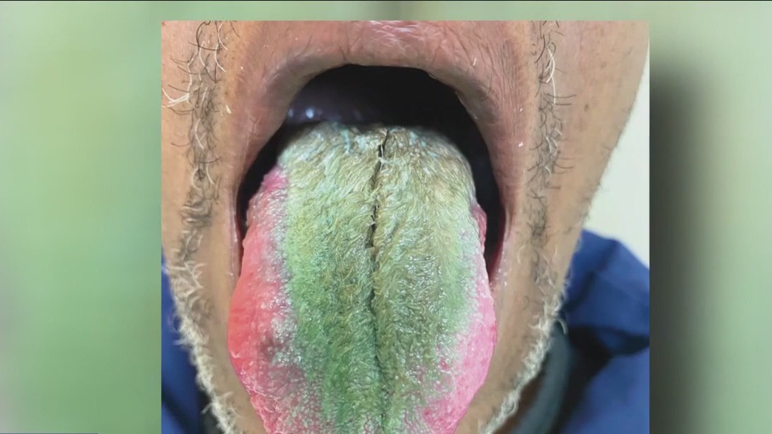 Man's tongue green after years of smoking