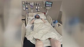 Houston man gets amputated after flea bite