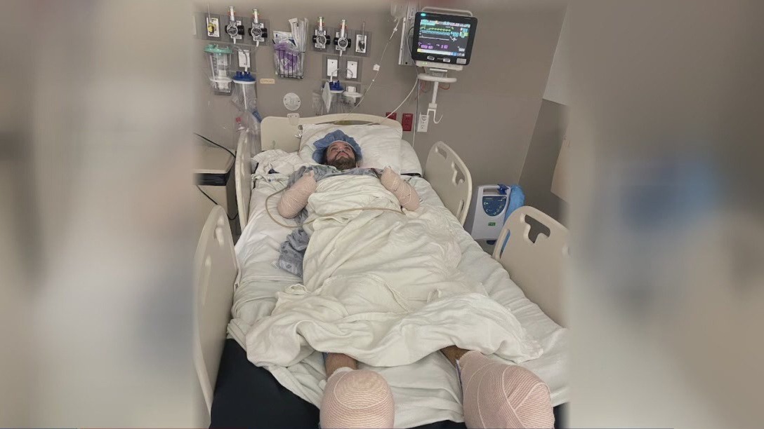 Houston man gets amputated after flea bite