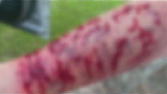 Texas woman attacked by snake, hawk