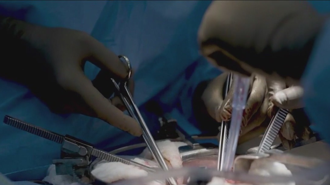 Pig's kidney transplanted into brain-dead man