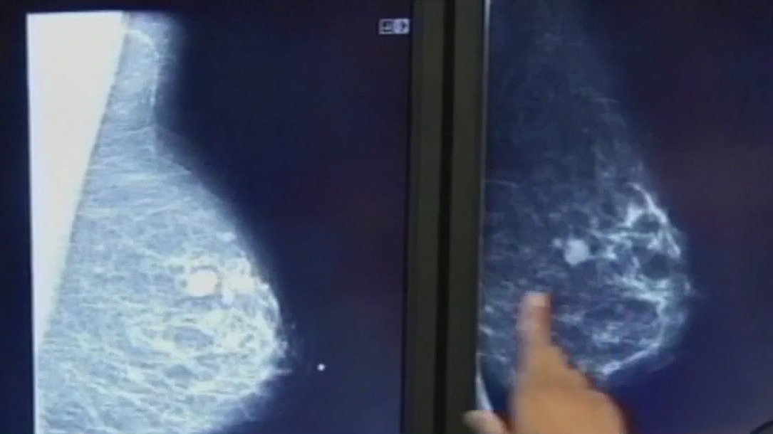 Study claims breast cancer tumors may differ based on race