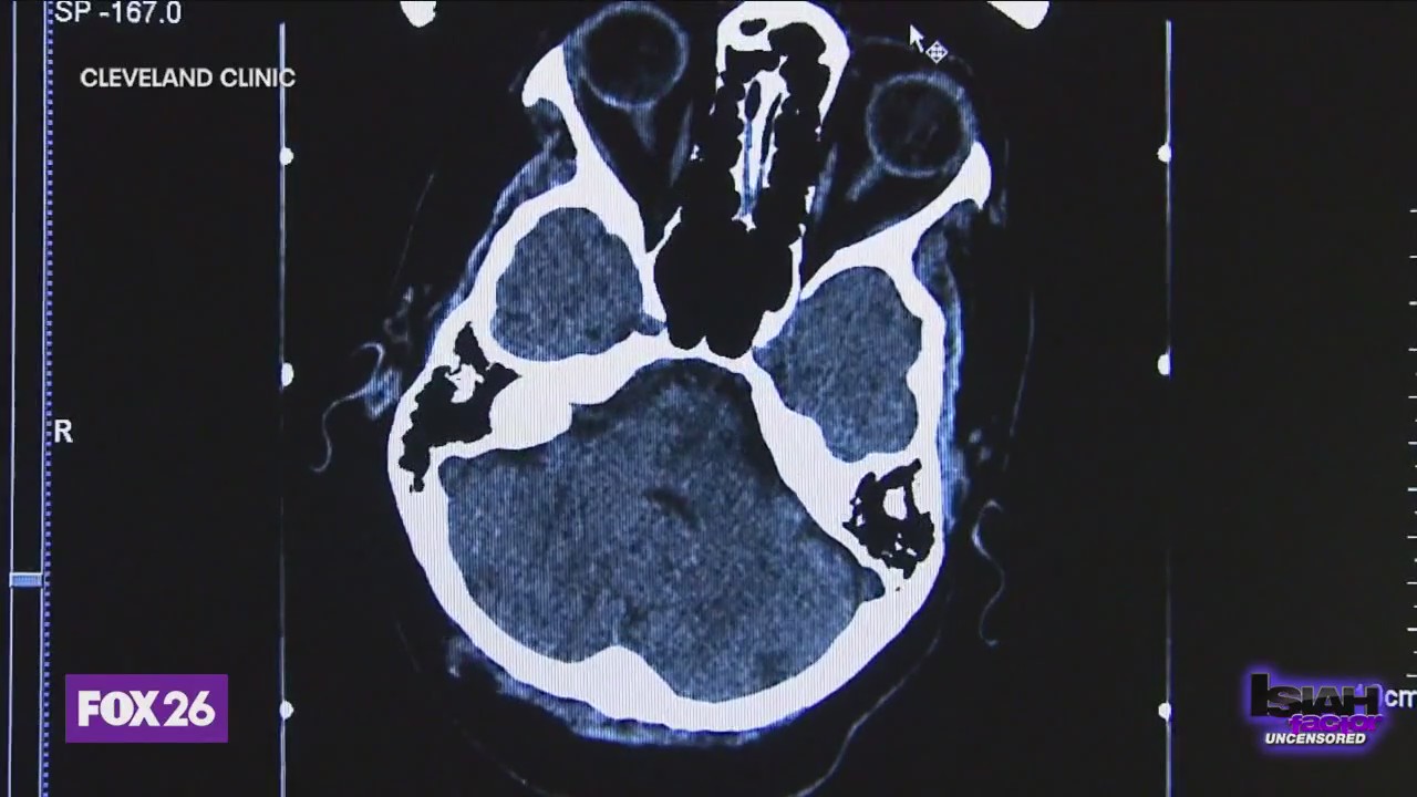 Study: Stroke deaths could reach near 10 million by 2050