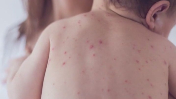 Taking precautions against the measles