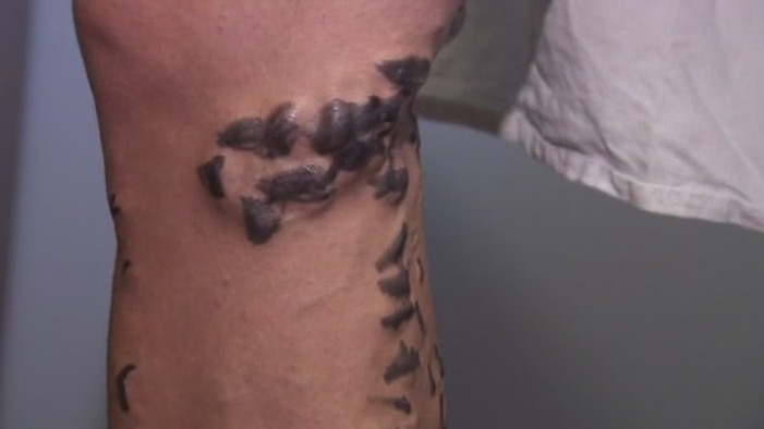 Coping with varicose veins