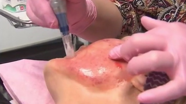 Vampire facials linked to HIV risks