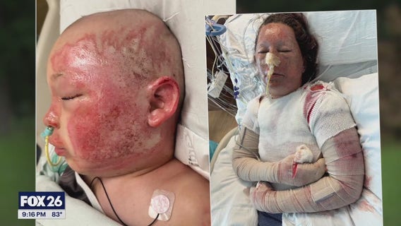 Houston grandmother, grandson burned due to storm