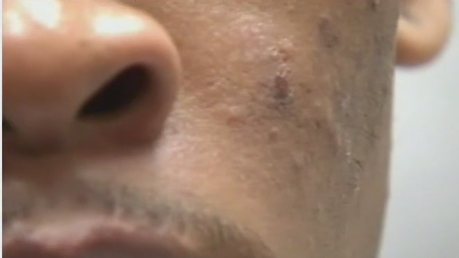 Best ways to treat acne