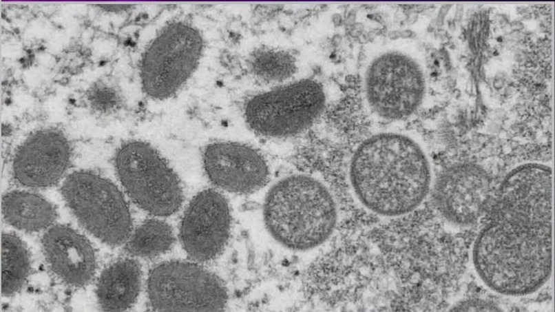 WHO declares Mpox outbreak a global health emergency