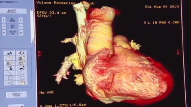 How to lower your resting heart rate