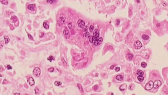 Texas county dealing with measles outbreak