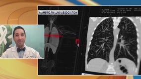 Study: lung cancer rising among non-smokers