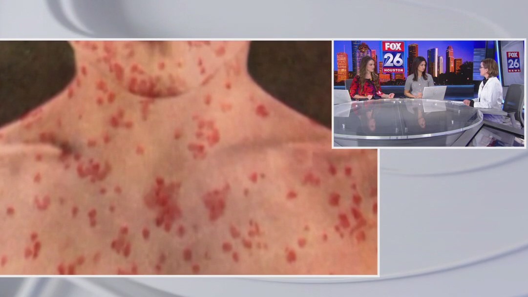 Texas measles outbreak: Doctor speaks on illness, MMR vaccine and more