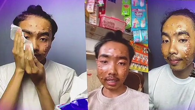 Man says he got a skin disease from second-hand clothing