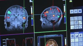 New drug shows promise reversing Alzheimer's