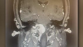 Lawsuit: Houston woman claims Pfizer birth control shot caused brain tumor