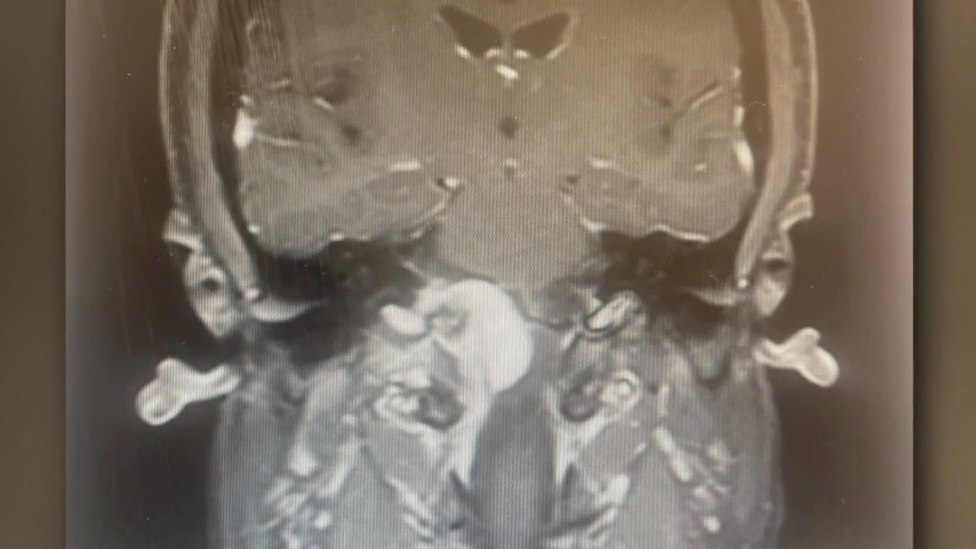 Lawsuit: Houston woman claims Pfizer birth control shot caused brain tumor