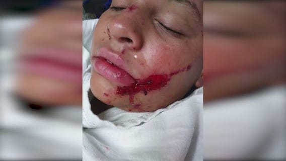 3 children hurt in San Bernardino fireworks accident