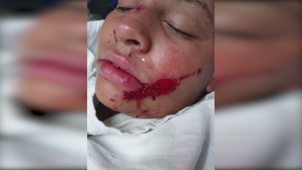 3 children hurt in San Bernardino fireworks accident