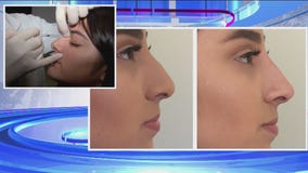 A look at the non surgical '5-minute nose job'