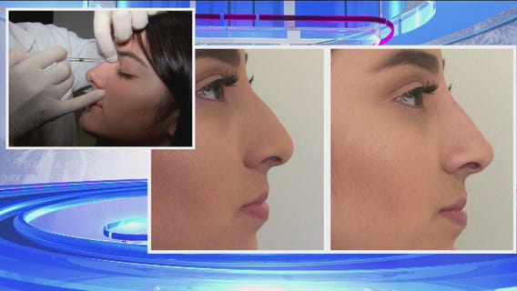 A look at the non surgical '5-minute nose job'