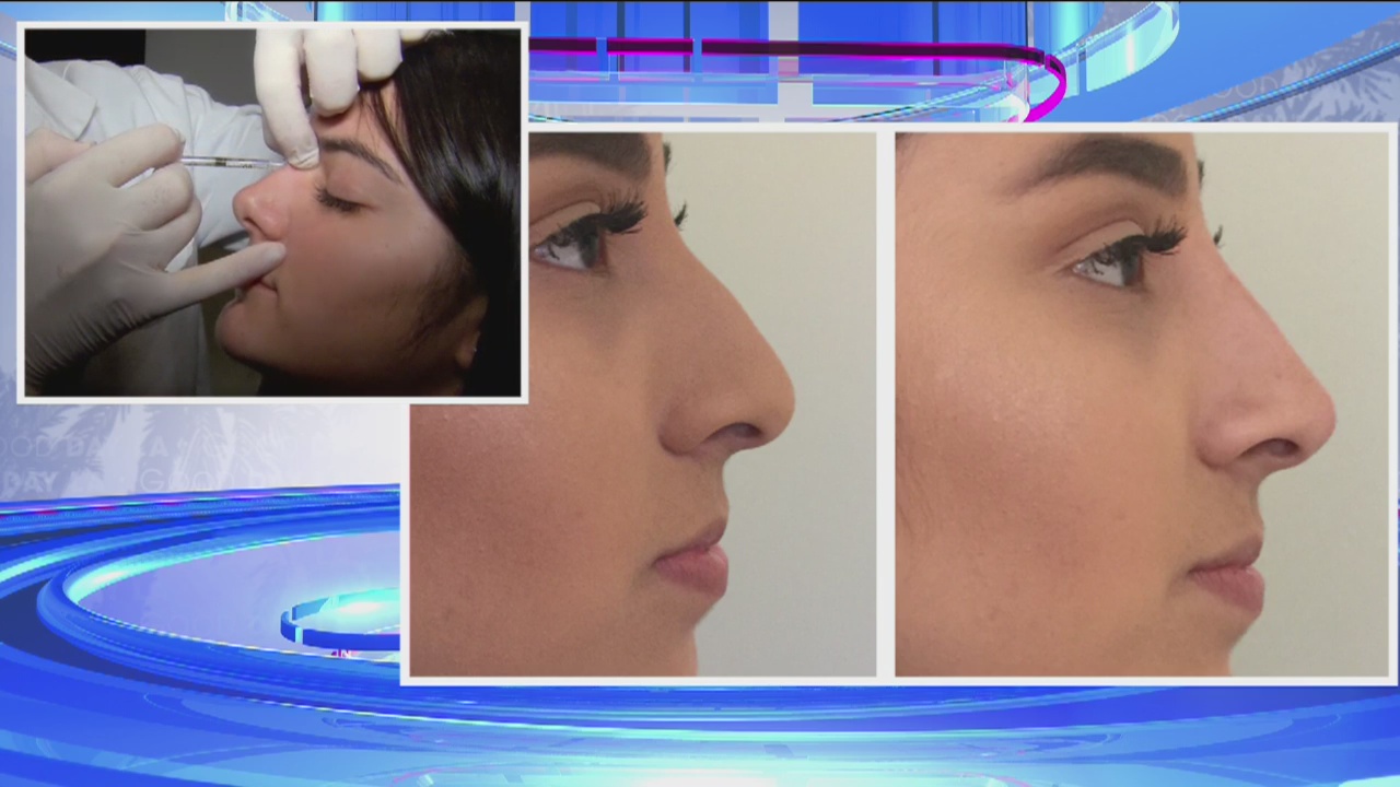 A look at the non surgical '5-minute nose job'