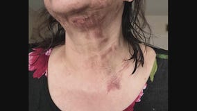 Woman speaks out about the NutriBullet giving her second-degree burns on her neck