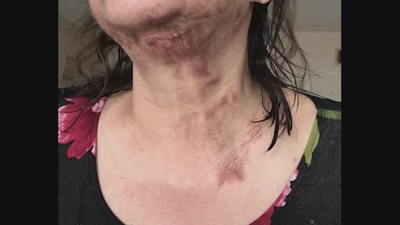 Woman speaks out about the NutriBullet giving her second-degree burns on her neck