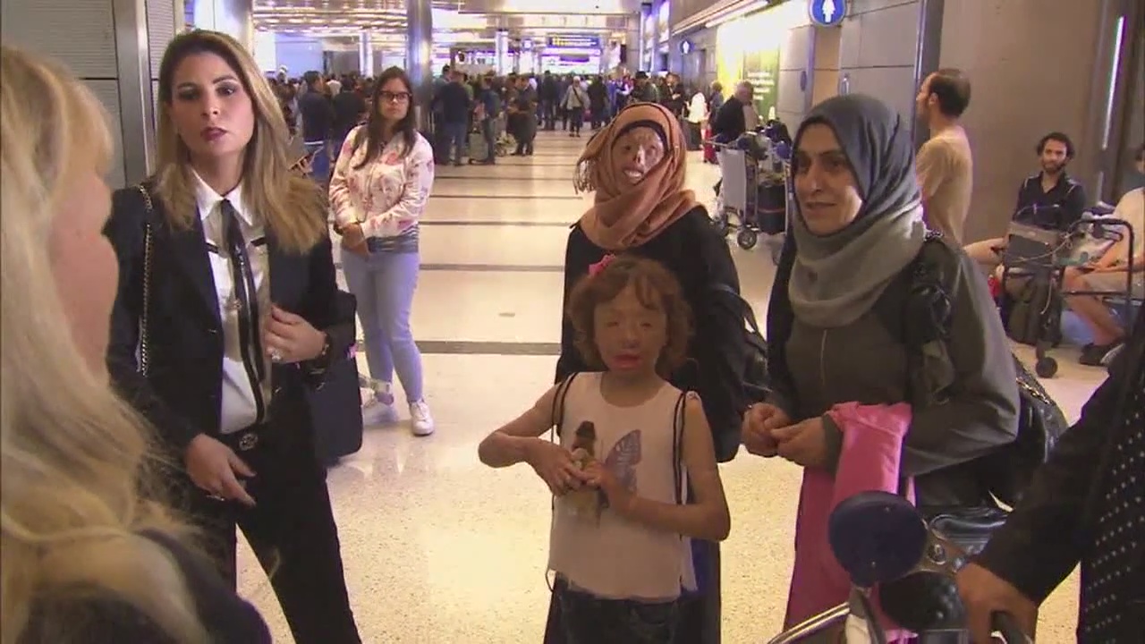 Burned Syrian Children