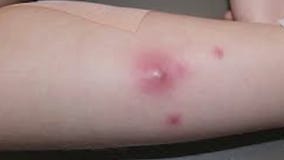 Multiple LAPD officers may have contracted MRSA