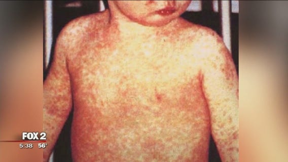 Henry Ford infectious disease doctor 'very concerned' about measles spike