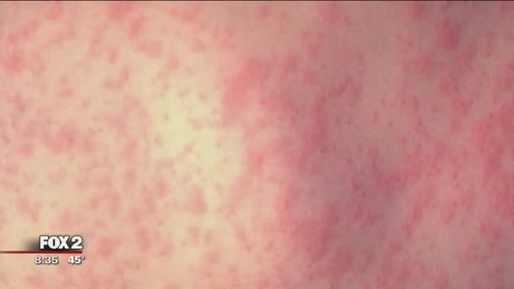 The Doctor Is In: Measles