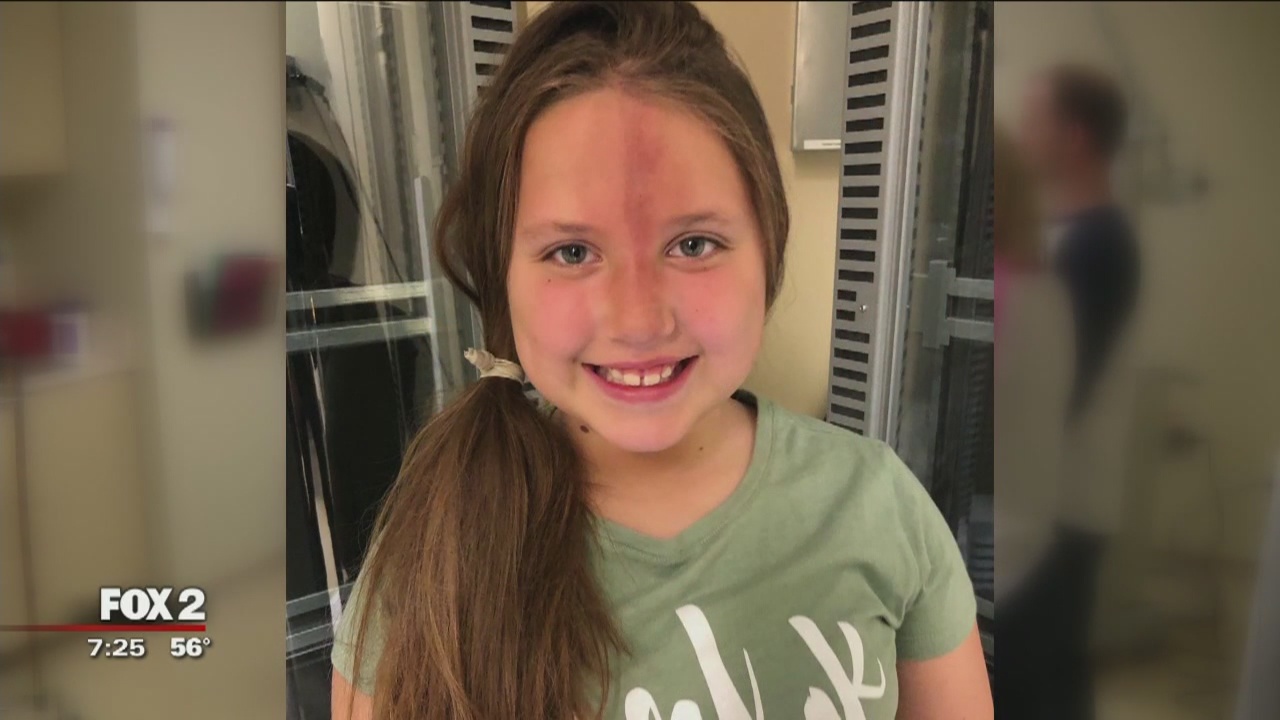 10-year-old Berkley girl making medical history with scleroderma treatment