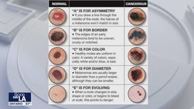 Skin cancer prevention: Mole checks