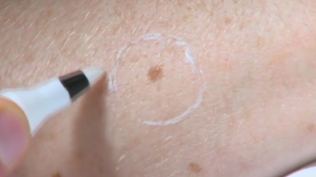 Custom skin cancer treatment cuts recurrence