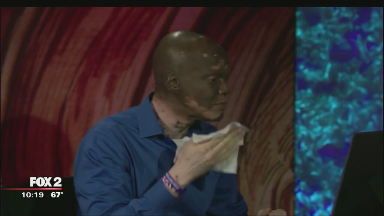 Lee Thomas gives TED Talk about learning positivity through vitiligo