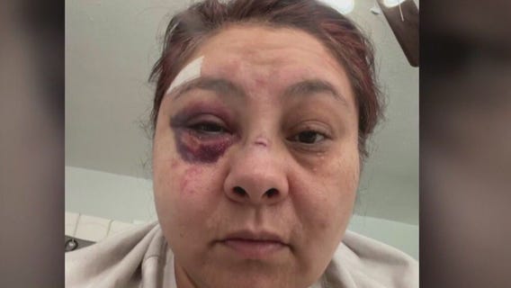 Woman severely beaten by man who tried to grab purse