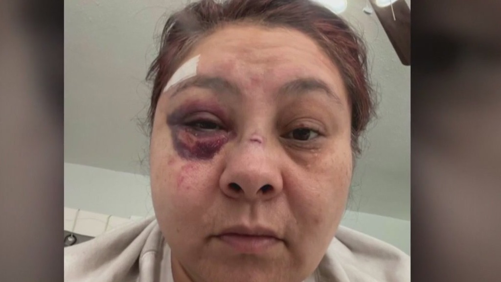 Woman severely beaten by man who tried to grab purse